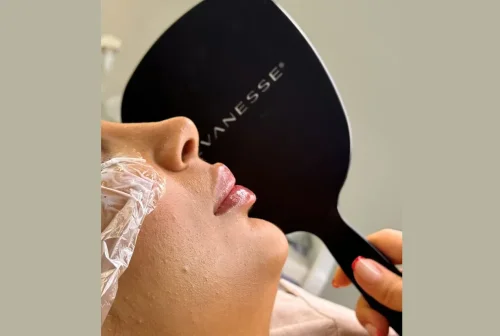 استفاده از فیلر لب چه تاثیری در زیبایی صورت دارد؟