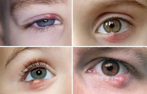 گل مژه از درمان های ساده تا خطاهای خطرناک