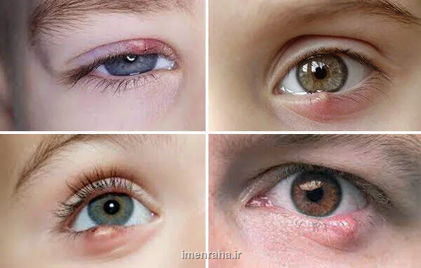 گل مژه از درمان های ساده تا خطاهای خطرناک