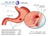 علت شایع درد ناگهانی معده